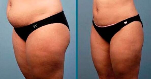 metody, jak zhubnout o 10 kilogramů za měsíc